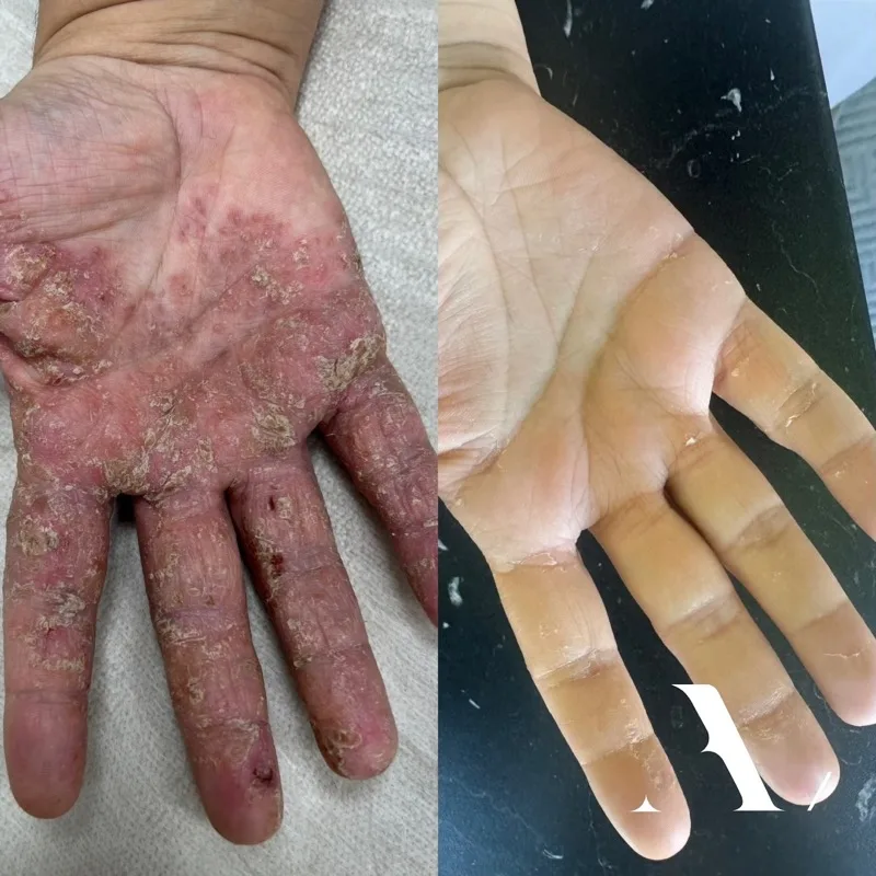 Resultatfoto från CAP-behandling vid Before/After Clinic – förbättrad hudkvalitet och ton